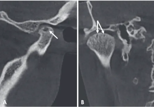 Fig. 6.  Corrected reformatted cone- cone-beam computed tomographic  imag-es of a rheumatoid arthritis patient  showing subchondral cysts  (ar-rows)