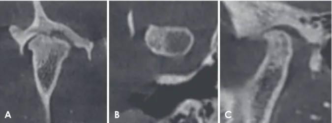 Fig. 8.  Reformatted cone-beam computed tomographic images of a rheumatoid arthritis patient