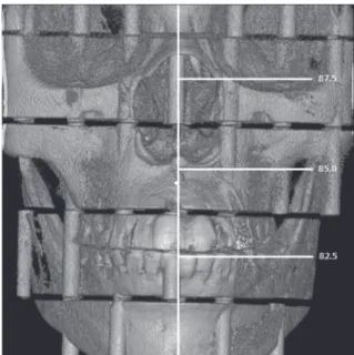 Fig. 3.  Coronal image of 3-dimensionally reconstructed cone- cone-beam computed tomography (I mode) of the phantom with  super-imposed PCXMC Z coordinates