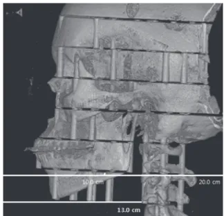 Fig. 5.  Lateral image of 3-dimensionally reconstructed cone-beam  computed tomography (P mode) of the phantom