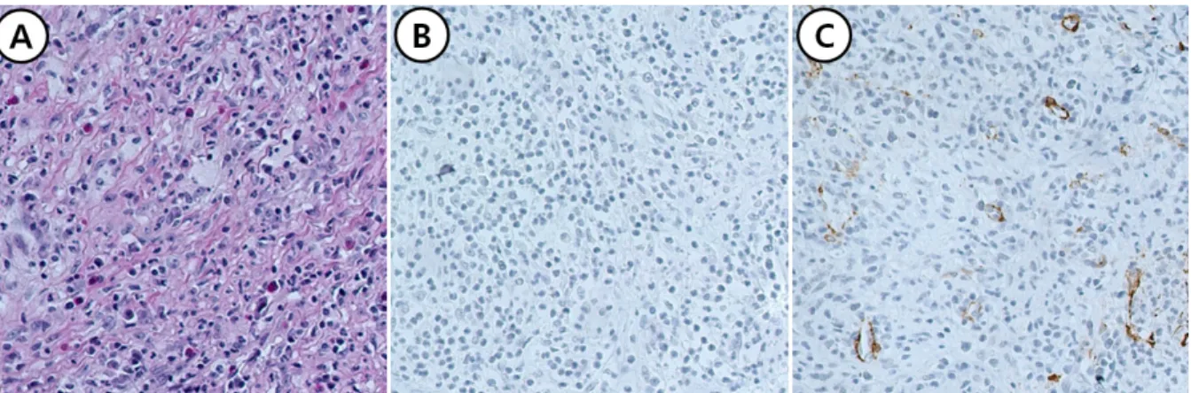 Fig. 2. Initial pathological findings of the patient. (A) There was myofibroblastic proliferative lesion, admixed with mixed in- in-flammatory cells, and no mitosis or necrosis