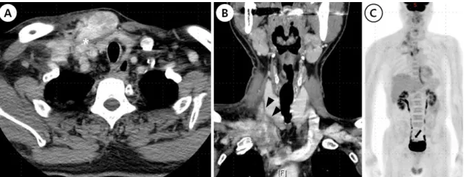 Fig. 3. Image findings of the patient after recurrence of the tumor. (A) Contrast enhanced axial CT scan demonstrated right up- up-per mediastinal mass with cystic change and irregular margin