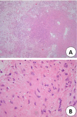 Fig. 4. The microscopic findings of the tumor. A:The tumor  shows the pattern of alternating Antoni A (hypercellular)  and B(hypocellular) areas (H-E, x40)