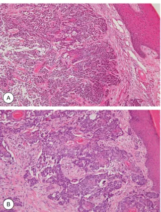 Fig. 3. (A) Histologic findings of upper lip mass. (H&amp;E staining, 