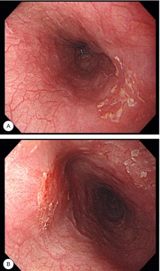 Fig. 5. (A) 3D printer reconstruction was used to reconstruct  a mandible. (B) Mandible reconstruction with fibula free  flap, planned by preoperative 3D printer reconstruction.