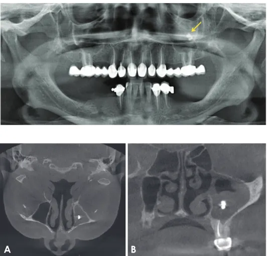 Fig. 1.  Panoramic radiograph shows  a radiopaque mass in the left  maxil-lary sinus. 