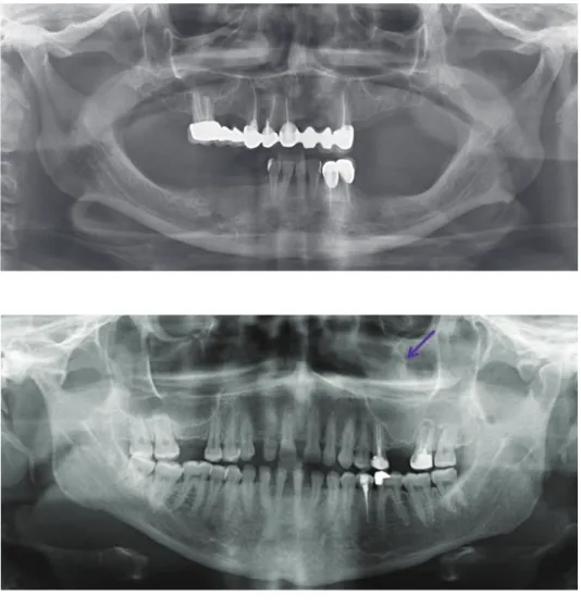 Fig. 5.  Panoramic radiograph shows  increased radiopacity in the left  maxillary sinus and the root of the  left maxillary first molar.