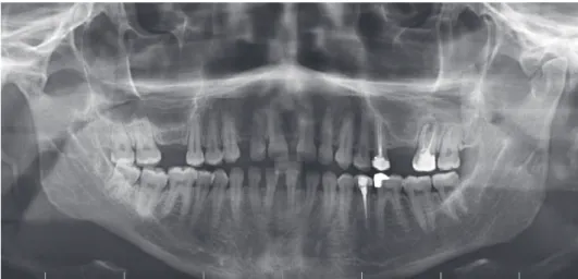 Fig. 8.  Postoperative panoramic  radiograph of the sinus at 1-year  follow-up.