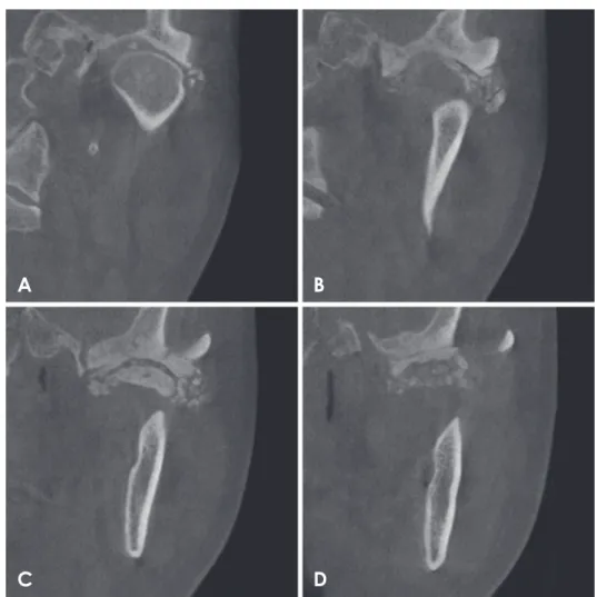 Fig. 3.  Coronal oblique cone-beam  computed tomographic (CBCT)  im-ages. A. Loose bodies are seen on  the superior and lateral sides of the  condyle