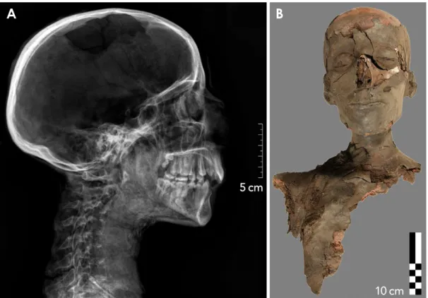 Fig. 1.  Example of a partial mummy excavated in tomb KV 40, specimen number KV 40 080