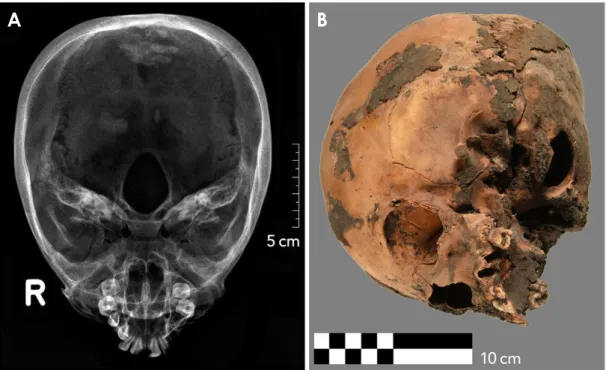 Fig. 3.  Example of a specimen classified as a skeletonized upper jaw (whole skull) excavated in tomb KV 40, specimen number KV 40  002