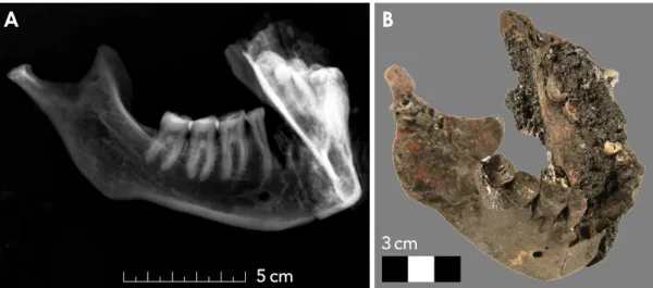 Fig. 4.  Example of a mandible excavated in tomb KV 40, specimen number 657. A. Conventional digital radiograph, where the later- later-al-oblique projection provides an optimal representation of the right tooth row