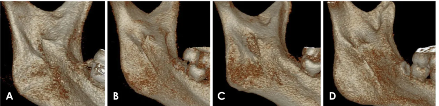 Table 1.  The location of the tip of the mandibular lingula in rela- rela-tion to the coronoid notch