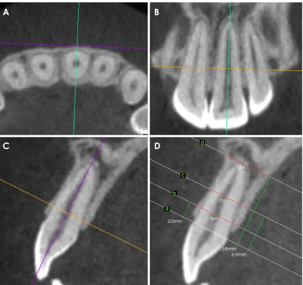 Fig. 2.  A. A cone-beam computed tomographic (CBCT) image in the axial plane sliced perpendicular to the labial or buccal contour of the  alveolar bone of the left central incisor