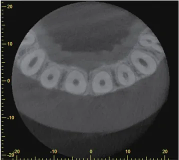 Fig. 2.  A pulp stone is found in a left lateral incisor on an axial  cone-beam computed tomographic slice.