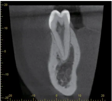 Fig. 3.  A pulp stone is seen in a lower premolar on a sagittal cone- cone-beam computed tomographic slice.
