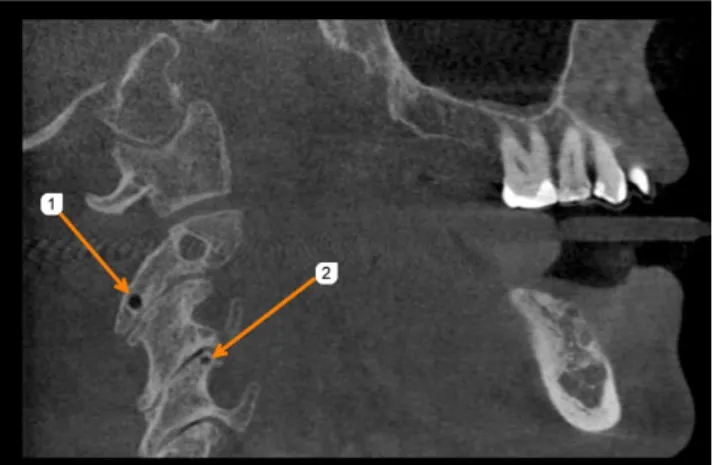 Fig. 2.  Sagittal cone-beam computed tomographic image shows a  large cystic lesion (#3) with sclerotic margins on the right lateral  mass of C-3.