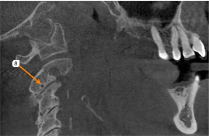 Fig. 6.  Sagittal cone-beam computed tomographic image shows a  small cystic lesion (#8) with sclerotic margin on C-2.