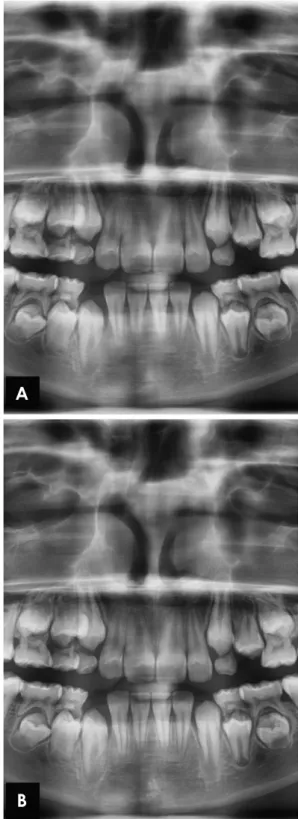 Fig. 2.  Subjective evaluation of the maxillary and mandibular an- an-terior maxillary premolar region