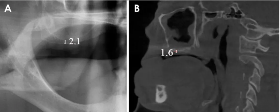 Fig. 1.  Measurement of the short- short-est vertical distance between the  alveolar crest and the bottom of the  maxillary sinus on a panoramic  im-age (A) and a cone-beam computed  tomography image (B).
