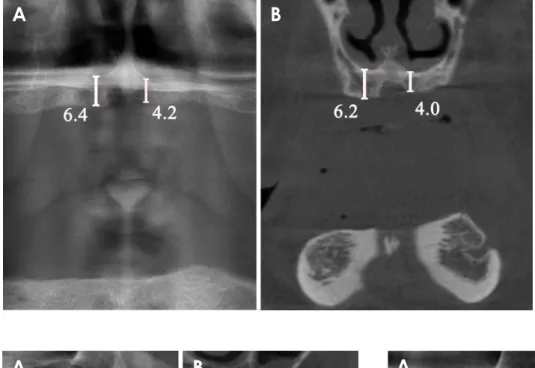 Fig. 2.  Measurement of the shortest  vertical distance between the  alveo-lar crest and the bottom of the nasal  floor on a panoramic image (A) and  a cone-beam computed tomography  image (B).