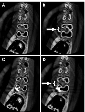 Fig. 3.  CBCT standard imaging protocol in axial images without  a metallic post and without a lesion (A), without a metallic post  and with a lesion (B, arrow with brace), with a metallic post and  without a lesion (C), and with a metallic post and with a