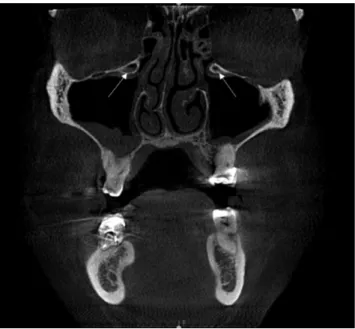 Fig. 1.  A coronal cone-beam computed tomography image demon- demon-strates accessory maxillary ostium in the right maxillary sinus with  ipsilateral maxillary sinusitis (white arrow).