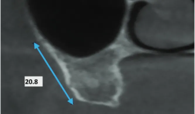 Fig. 1.  Distance from the lower border of the artery to the alveolar  crest.