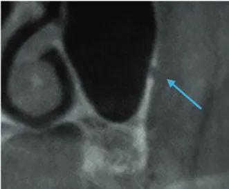 Fig. 3.  Coronal view of the maxillary sinus, showing the artery (arrow), which is below the membrane.