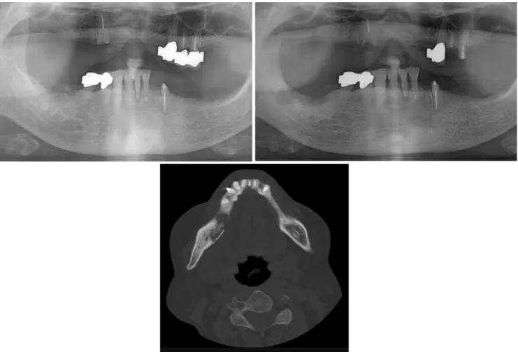 Fig. 2.  Panoramic radiographic view of a bisphosphonate-related osteonecrosis of the jaw (BRONJ) patient prior to the extraction of the  root remnant of the right mandibular first molar (upper left) and panoramic view (upper right); computed tomographic s