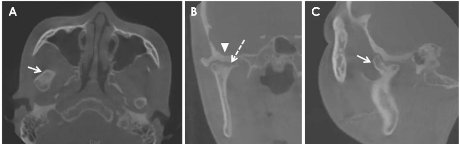 Fig. 3.  A-C. Cone-beam computed tomography (CBCT) images demonstrate the well-defined margin of the radiopaque mass on the an- an-teromedial surface of the condylar neck (arrow) with a focal erosive change (dotted arrow)