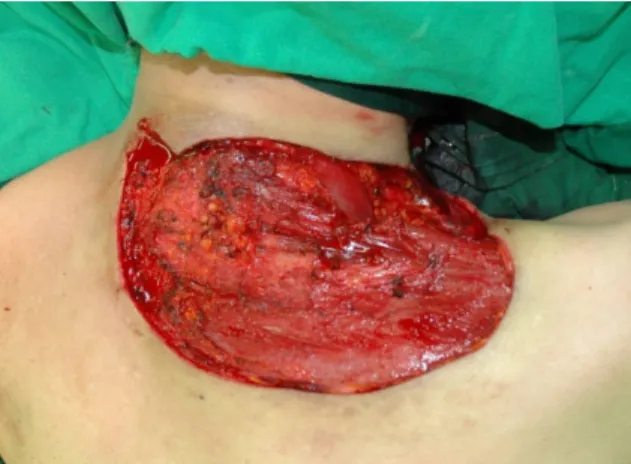 Fig. 5. Excised tumor, gross view. The mass was completely  excised with ligation of the neovascularized vessels and  weighed 580g.