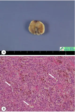 Fig. 3. Pathologic findings. The cut surface of resected mass  shows irregular shaped grayish white soft tissue(A)