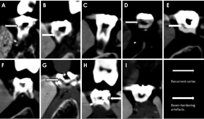 Table 1.  Nine different cone-beam computed tomography imag- imag-ing settimag-ings used in this study
