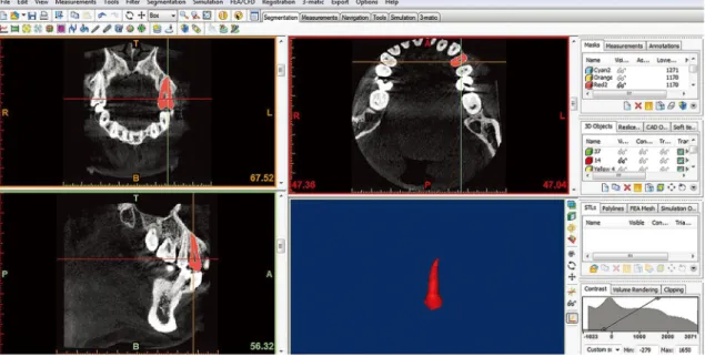 Fig. 1.  Digital Imaging and Communications in Medicine (DICOM) datasets of the patients are imported into Mimics ®  Innovation Suite  15.01 and reconstructed.
