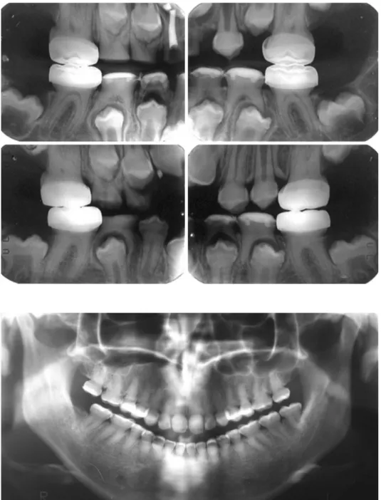 Fig. 2.  Radiographic images of  the 7-year-old patient. Temporary  stainless steel crowns are present  in the permanent first molars, and  direct composite resin restorations  are present in the primary  mandib-ular molars.