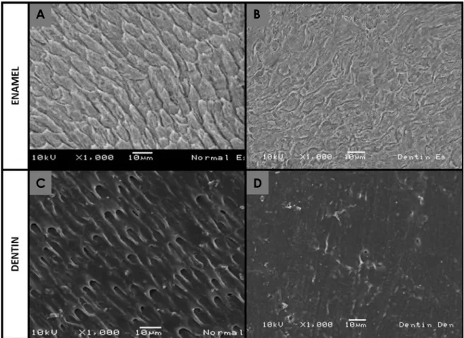 Fig. 4.  Scanning electron microscopy images (×1000) show the enamel and dentin of both a normal tooth and a tooth affected by den- den-tinogenesis imperfecta