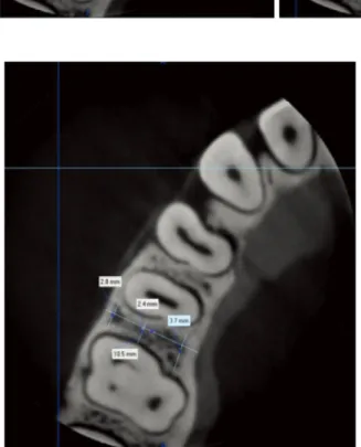 Fig. 4.  A. Preoperative 360° small-  volume cone-beam computed  to-mography (CBCT) rotational scan  of the mini-implant placement site