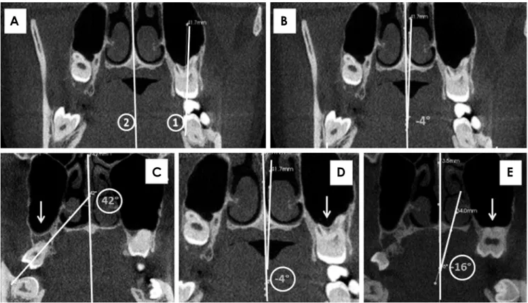 Fig. 1.  Coronal cone-beam computed tomography sections. A. Line 1 passing through the long axis of the maxillary third molar and line 2  passing through the midsagittal plane