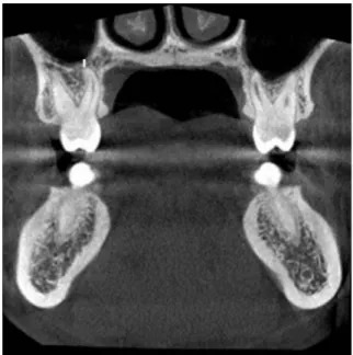 Fig. 2.  Screen capture shows the distance between the root apex of  the maxillary posterior teeth and maxillary sinus floor (white line).