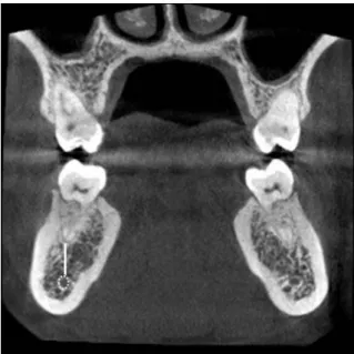Fig. 3.  Screen capture shows the distance (white line) between the  root apex of the mandibular posterior teeth and mandibular canal (dotted white circle).