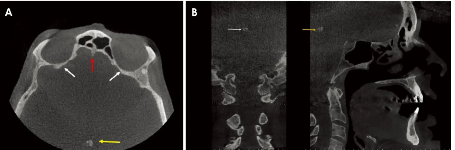 Fig. 1.  A. Axial cone-beam computed tomography (CBCT) section. Arrows depict the pineal gland calcification (yellow), the crista galli (red), and the orbital cavity (white)