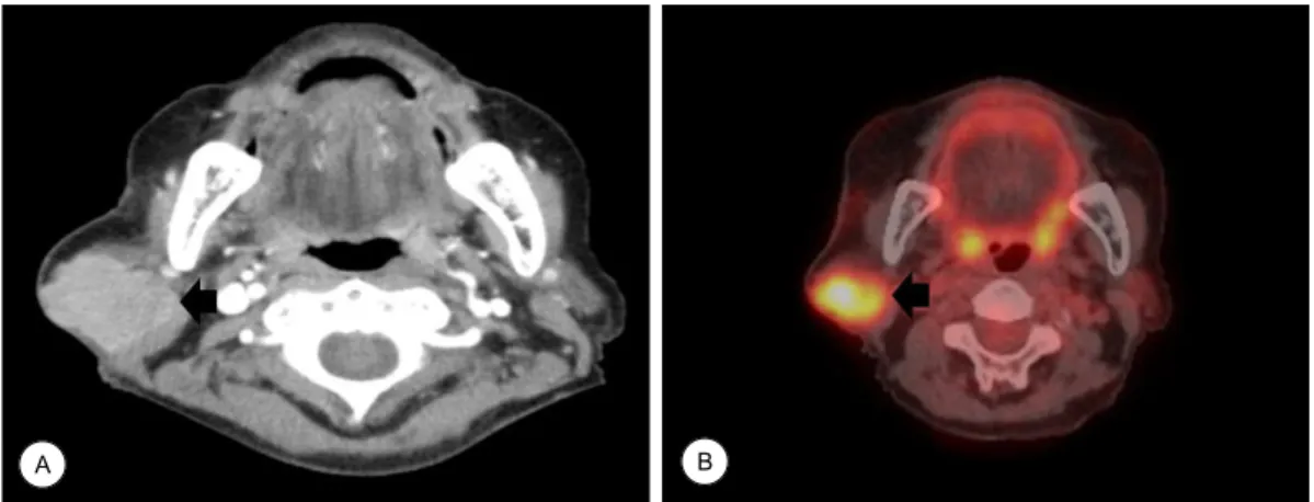 Fig. 1. Preoperative computed tomography and positron emission tomography.  (A) Preoperative contrast enhanced neck CT scan  shows a parotid mass on the right parotid gland (arrow)