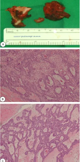 Fig. 3. Histopathological findings. A. Pathologic specimen of  coronoid process, tumor, and pterygoid muscle