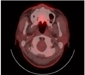 Fig. 3. Postoperative PET-CT. There is no evidence of recurrence  and metastasis in 5 years after surgery.