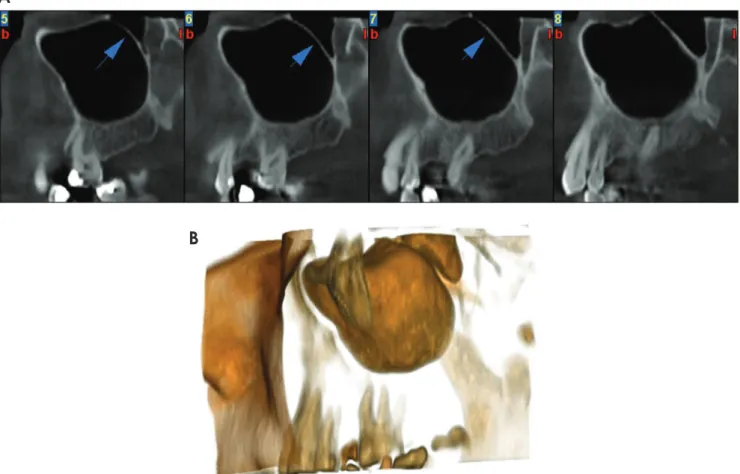 Fig. 1.  Class IV sinus septal pattern: 2 long partial perpendicular septa (arrows) that are not limited to the base of the sinus in cross-section- cross-section-al (A) and three-dimensional (B) images.