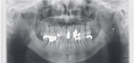 Fig. 1.  Panoramic radiograph shows  the ovoid radiolucent area in the  left mandibular ramus (arrow).