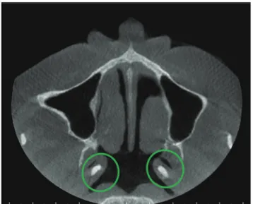 Fig. 1.  Coronal cone-beam computed tomography image reveals  bilateral calcifications (circles) of the cartilaginous Eustachian  tube.