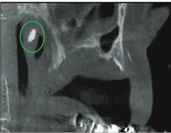 Fig. 4.  Volume rendering demonstrates the Eustachian tube calcifi- calcifi-cations (circle).