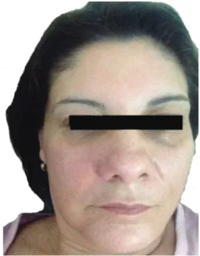 Fig. 1.  Swelling and mild redness is seen of the right nasolabial  fold.